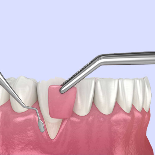 Bone-and-Gum-Suegery